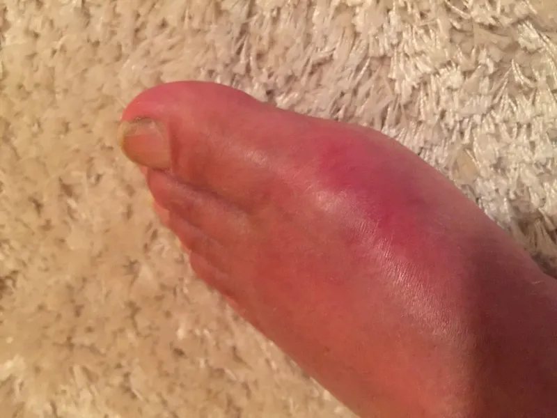 Swollen big toe joint for a uric acid test